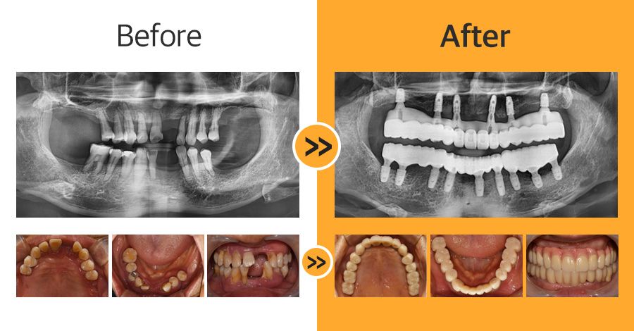 올온엑스 임플란트 증례01