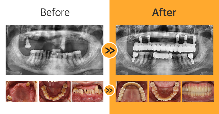 올온엑스 임플란트 증례02
