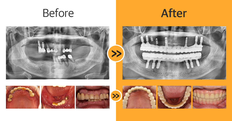 올온엑스 임플란트 증례03