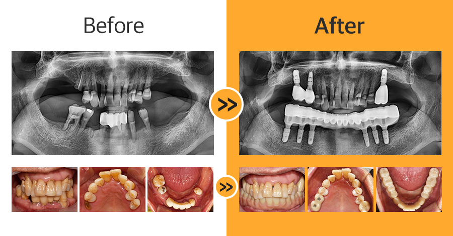 올온엑스 임플란트 증례04