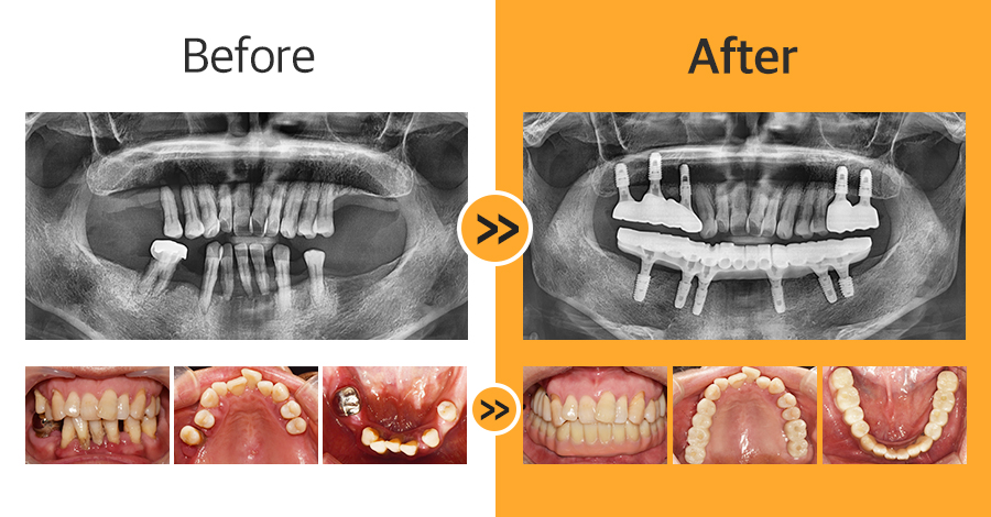 올온엑스 임플란트 증례05