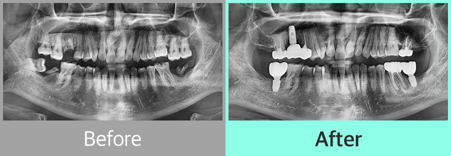 디지털 임플란트 증례01