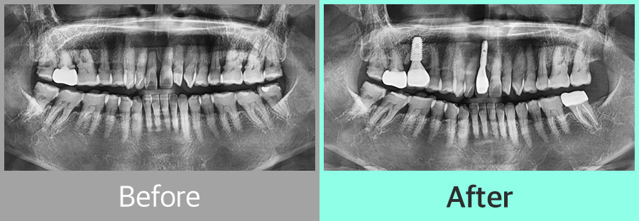 디지털 임플란트 증례03