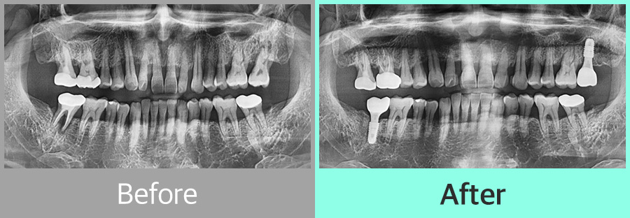 디지털 임플란트 증례04