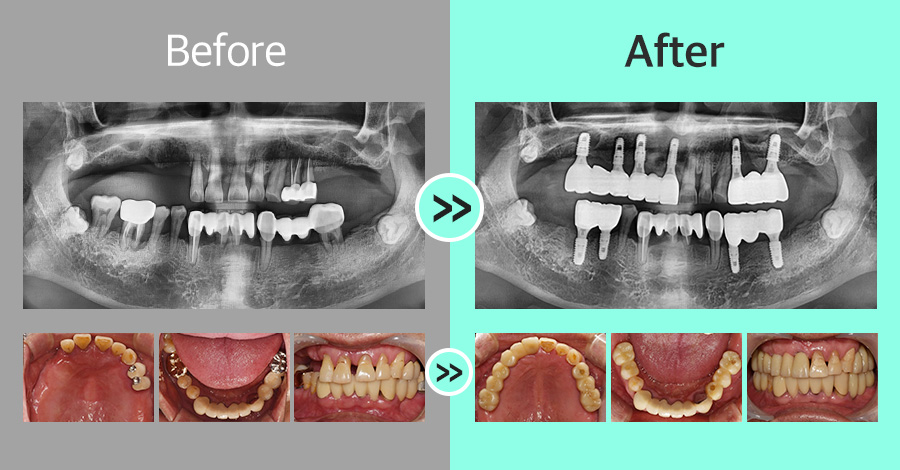 디지털 임플란트 증례08