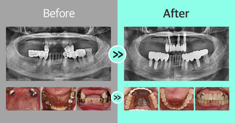 디지털 임플란트 증례09