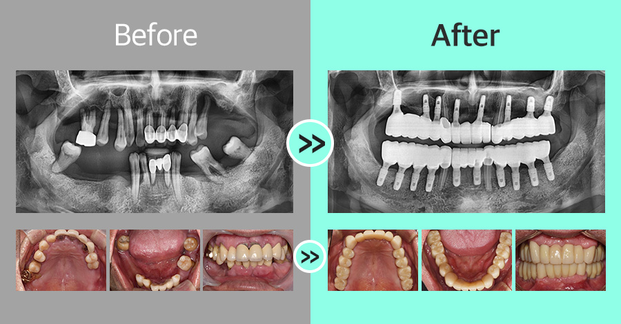 디지털 임플란트 증례10